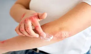 بهترین کرم‌های ایرانی برای کنترل اگزما