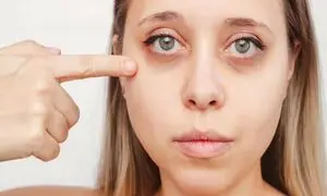 آیا پف زیر چشم هم جزو اورژانس های چشمی محسوب می‌شود؟