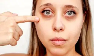 آیا پف زیر چشم هم جزو اورژانس های چشمی محسوب می‌شود؟