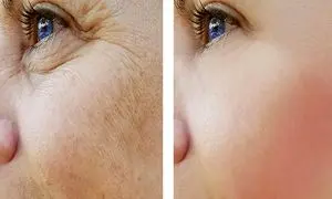 ۱۰ روش جوانسازی پوست در اصفهان