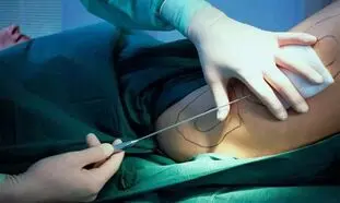 اطلاعات مهم درباره مراحل پیکرتراشی قبل از عمل زیبایی