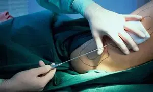 اطلاعات مهم درباره مراحل پیکرتراشی قبل از عمل زیبایی