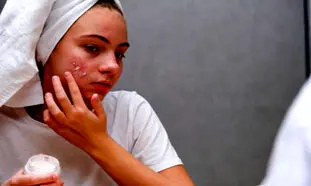 کرم ضد جوش و آکنه را از چه برندی بخریم؟