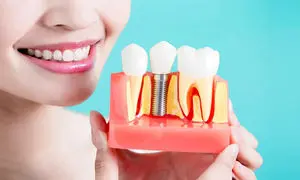 راهنمای انتخاب دندانپزشکی مطمئن برای ایمپلنت در شیراز
