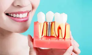راهنمای انتخاب دندانپزشکی مطمئن برای ایمپلنت در شیراز