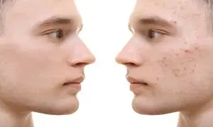 عرضه سرم برطرف کننده جوش صورت دیپ‌ سنس