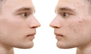 عرضه سرم برطرف کننده جوش صورت دیپ‌ سنس