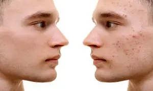 عرضه سرم برطرف کننده جوش صورت دیپ‌ سنس