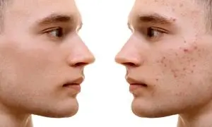 عرضه سرم برطرف کننده جوش صورت دیپ‌ سنس