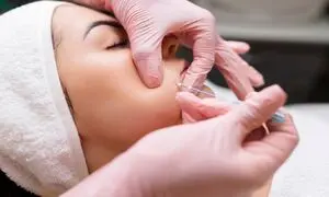مزایای لیفت صورت با نخ کدام است؟