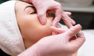 مزایای لیفت صورت با نخ کدام است؟