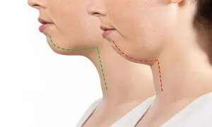 جراحی فک مناسب چه کسانی است؟