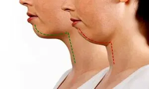 جراحی فک مناسب چه کسانی است؟