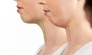 جراحی فک مناسب چه کسانی است؟