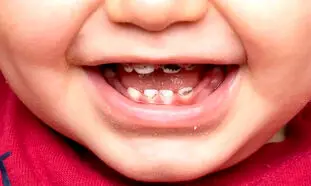 پوسیدگی دندان شیری؛ آیا واقعا درمان آن ضروری است؟