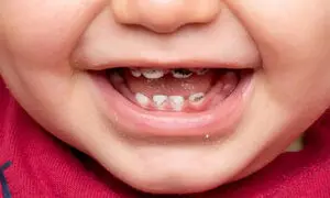 پوسیدگی دندان شیری؛ آیا واقعا درمان آن ضروری است؟