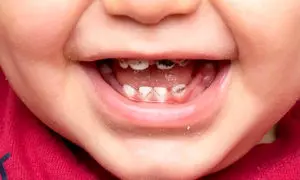 پوسیدگی دندان شیری؛ آیا واقعا درمان آن ضروری است؟