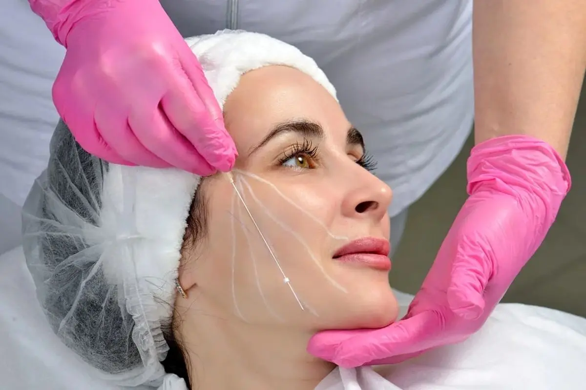 برای لیفت صورت با نخ در شاهین شهر به کدام کلینیک مراجعه کنیم؟