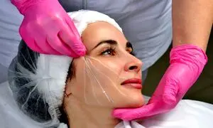 برای لیفت صورت با نخ در شاهین شهر به کدام کلینیک مراجعه کنیم؟
