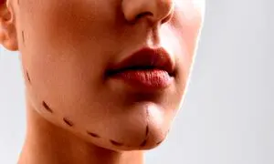 جراحی چانه چه قدر در زیبایی دختران جوان اثرگذار است؟