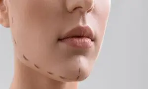 جراحی چانه چه قدر در زیبایی دختران جوان اثرگذار است؟