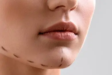 جراحی چانه چه قدر در زیبایی دختران جوان اثرگذار است؟