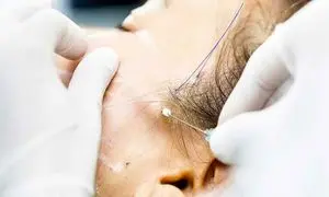 برای لیفت صورت بهتر است نخ استفاده کرد یا جراحی سنگین؟