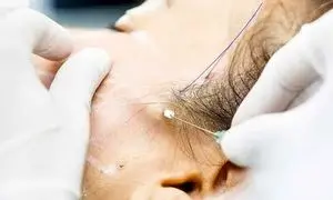 برای لیفت صورت بهتر است نخ استفاده کرد یا جراحی سنگین؟