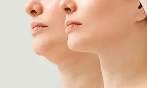 بهترین روش‌های رفع غبغب در اصفهان؛ کدام تکنیک برای شما مناسب‌تر است؟