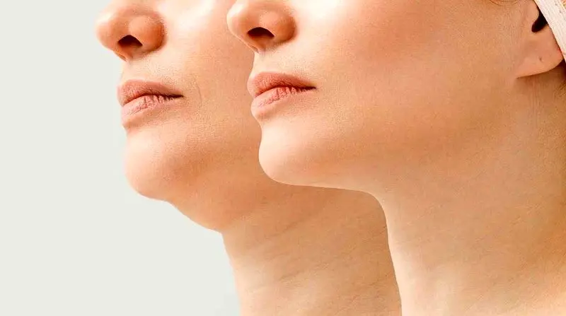 بهترین روشهای رفع غبغب در اصفهان؛ کدام تکنیک برای شما مناسبتر است؟