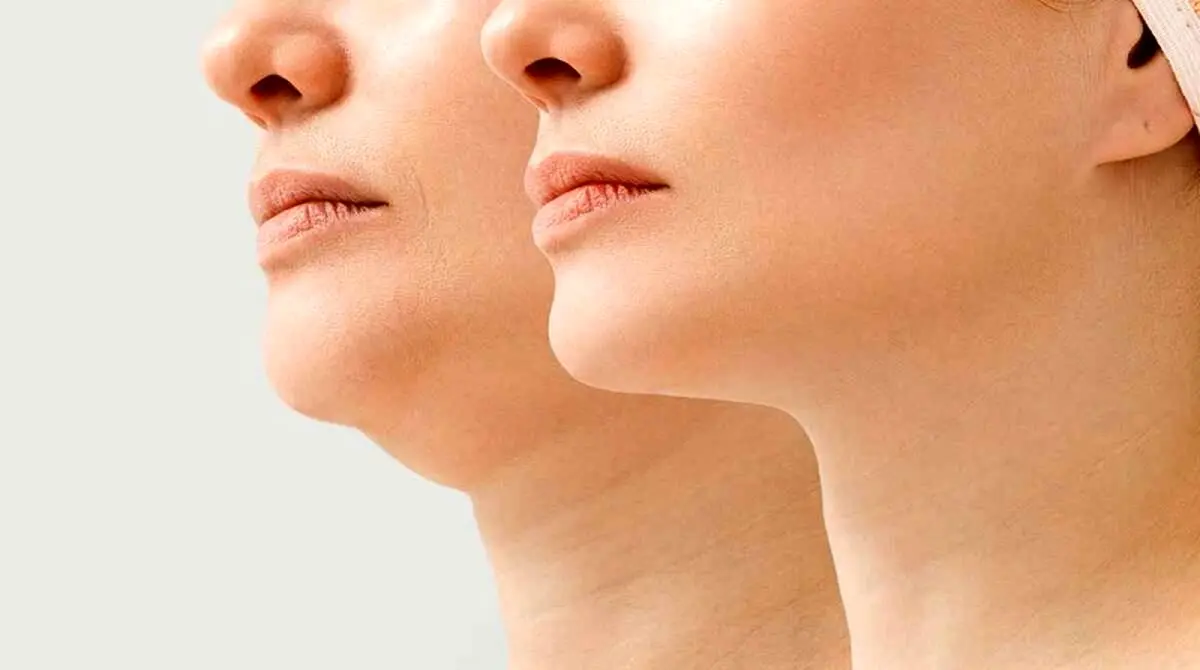 بهترین روش‌های رفع غبغب در اصفهان؛ کدام تکنیک برای شما مناسب‌تر است؟