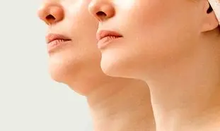 بهترین روش‌های رفع غبغب در اصفهان؛ کدام تکنیک برای شما مناسب‌تر است؟
