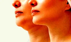 بهترین روش‌های رفع غبغب در اصفهان؛ کدام تکنیک برای شما مناسب‌تر است؟