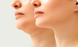 بهترین روش‌های رفع غبغب در اصفهان؛ کدام تکنیک برای شما مناسب‌تر است؟